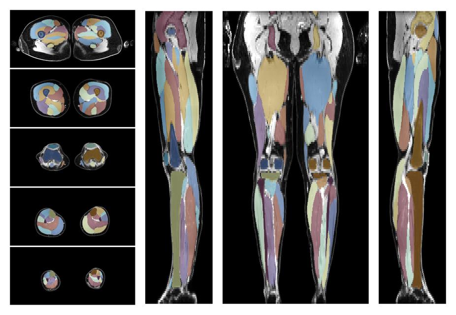 Overlay of automated muscle segmentation labels on dixon water image.